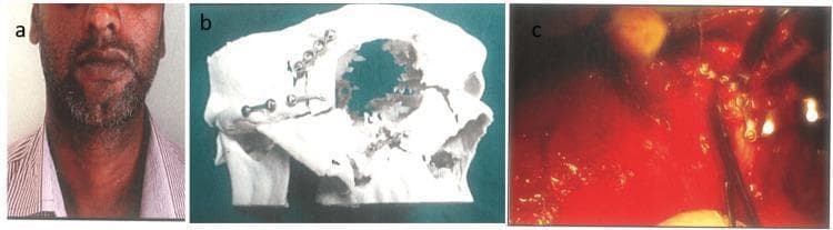 This composite figure illustrates the surgical management of a complex zygomatico-orbital fracture. Panel (a) is a clinical photograph showing a 32-year-old male with facial asymmetry and post-traumatic deformity on the right side. Panel (b) displays a 3D-printed stereolithographic model of the patient's zygomatico-orbital complex, utilized for preoperative simulation. On the model, pre-adapted 1.5 mm titanium hardware is visible: a two-hole miniplate with a central gap is fixed over the zygomatic arch, and a four-hole miniplate with a gap is positioned across the infraorbital rim fracture site. Panel (c) is an intraoperative clinical photograph demonstrating the semi-rigid fixation phase. The pre-adapted miniplates are seen secured with screws to the fractured bone segments within the surgical field, which includes visible soft tissue and surgical retractors. This sequence demonstrates the use of patient-specific modeling to achieve anatomical reduction and stable internal fixation in maxillofacial reconstructive surgery.