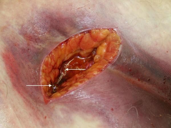 This clinical photograph shows a post-mortem incision into necrotic tissue, illustrating a case of gas gangrene (clostridial myonecrosis). The primary focal point is a surgical opening in the skin and subcutaneous layer, revealing underlying necrotic adipose and myofascial tissue with a characteristic reddish-orange to dusky brown discoloration. Within the incision, there is a prominent collection of serosanguinous fluid containing numerous gaseous bubbles, marked by white arrows, which represent the metabolic byproducts of anaerobic bacteria like Clostridium septicum. The surrounding skin exhibits extensive ecchymosis and dark purple purpura, suggesting severe subcutaneous hemorrhage and impaired perfusion. The skin's surface appears tense and glistening, indicative of underlying edema and crepitus. This image serves as a critical educational example of the rapid tissue destruction and gas formation characteristic of necrotizing soft tissue infections (NSTI) and fulminant sepsis.