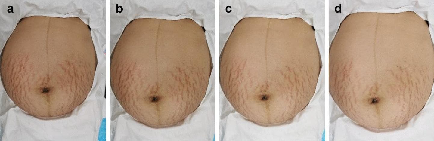 This clinical photographic series consists of four sequential images (a-d) showing the progression of striae gravidarum (stretch marks) on a female abdomen during a therapeutic intervention. Image 'a' demonstrates the baseline state with numerous erythematous (reddish-purple) striae rubra, primarily concentrated in the lower quadrants and periumbilical region. The lesions are characterized by high density, moderate width, and distinct longitudinal morphology against a slightly inflamed skin tone. A visible linea nigra is also present along the midline. Panel 'b' (week 2) and 'c' (week 4) show a gradual reduction in erythema, with the lesions becoming lighter pink and less visually prominent. By panel 'd' (week 8), the striae exhibit significant clinical improvement, characterized by a transition to a paler, more subtle appearance with reduced lesion width and overall density. The surrounding skin texture appears smoother, reflecting a decrease in local inflammation and a shift toward the appearance of striae alba.
