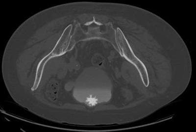 This diagnostic image is an axial CT scan of the pelvis, performed in the prone position. It demonstrates a classic 'jackstone' urinary bladder calculus, characterized by its highly hyperdense, spiculated, and star-shaped morphology with a dense central core. The calculus is located anteriorly within the bladder lumen, which also contains layered contrast material from a delayed phase study. Additionally, a distinct outpouching or diverticulum is visible on the left lateral wall of the bladder. The surrounding pelvic anatomy, including the hyperdense iliac bones and sacrum, as well as the pelvic musculature and soft tissues, are well-visualized. This case illustrates key radiological features of specialized bladder calculi often associated with urinary stasis or chronic infection. The image serves as a high-quality educational example of obstructive uropathy and vesical lithiasis for urology and radiology trainees.