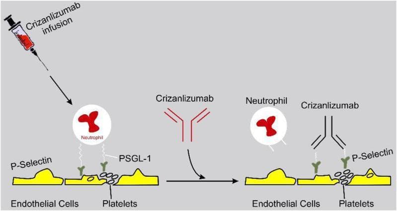 This pathophysiology diagram illustrates the mechanism of action of Crizanlizumab in managing vaso-occlusion, particularly relevant to sickle cell disease. The illustration is divided into two comparative stages: pretreatment (left) and post-treatment (right). On the left, a neutrophil is shown adhering to the vascular endothelium and activated platelets. This adhesion is mediated by the interaction between P-selectin, expressed on the surface of endothelial cells and platelets, and P-selectin glycoprotein ligand-1 (PSGL-1) located on the neutrophil. In the center, a syringe depicts the infusion of Crizanlizumab, a humanized monoclonal antibody. On the right, the diagram demonstrates the therapeutic effect: Crizanlizumab molecules bind directly to P-selectin on the endothelial cells and platelets. This binding competitively inhibits the P-selectin/PSGL-1 interaction, resulting in the detachment of the neutrophil from the vessel wall and preventing further leukocyte adhesion. The diagram highlights the drug's role in reducing multicellular adhesion and subsequent vaso-occlusive crises.