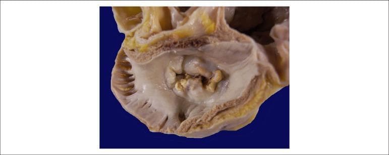 This clinical photograph shows a gross pathological specimen of a human heart, specifically an atrial view of the mitral valve. The image demonstrates hallmark signs of chronic rheumatic heart disease. Key features include significant thickening and fibrosis of the valve leaflets, resulting in a 'fish-mouth' or 'buttonhole' appearance of the valvular orifice. There is evidence of extensive commissural fusion and multiple focal areas of yellowish-white calcification along the leaflet margins and within the valve body. These structural changes characterize severe mitral stenosis, where the restricted opening of the valve impairs blood flow from the left atrium to the left ventricle. The surrounding atrial endocardium appears thickened, consistent with chronic pressure overload. This visual is highly representative for educational purposes in cardiology and pathology to illustrate the long-term sequelae of rheumatic fever on cardiac valves.