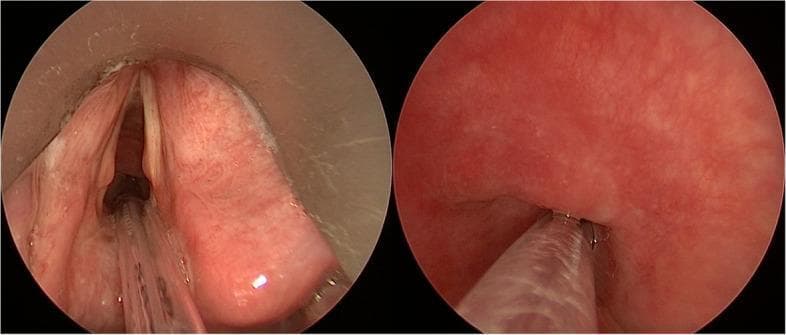 This endoscopic clinical photograph displays two laryngoscopic views of a patient with severe subglottic stenosis undergoing specialized intubation. The left panel shows a supraglottic view where the vocal cords appear as pale, whitish bands. The surrounding laryngeal mucosa is erythematous and congested. Centrally, a clear, ultrathin Tritube endotracheal tube is visible, inserted through a significantly narrowed subglottic opening. Small amounts of white, mucoid secretions are noted along the peripheral laryngeal structures. The right panel provides a subglottic view, demonstrating the distal portion of the clear endotracheal tube positioned within the trachea. The tracheal walls appear intensely erythematous and inflamed, with a concentric narrowing consistent with severe stenosis. There is a lack of normal tracheal rings' definition, indicating chronic inflammatory or cicatricial changes. This comparison highlights the anatomical challenges of managing a compromised airway and the use of small-lumen ventilation tubes to maintain oxygenation while maximizing surgical exposure in the laryngeal and tracheal regions.