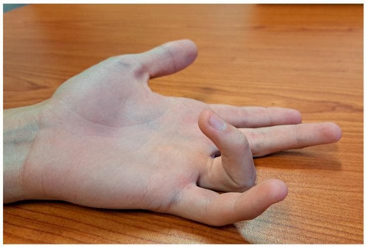 This clinical photograph shows the left hand of a 15-year-old patient in a supinated position, illustrating a presentation of a pediatric trigger finger. The ring finger (fourth digit) demonstrates a localized fixed flexion deformity at the proximal interphalangeal (PIP) joint, while the distal interphalangeal (DIP) joint remains relatively neutral. This visual captures the 'locking' or 'snapping' phenomenon characteristic of stenosing tenosynovitis, where the flexor tendon becomes trapped under the A1 pulley. In comparison, the index, middle, and small fingers are mostly extended, and the thumb is adducted with slight flexion at the metacarpophalangeal (MCP) joint. The image serves as an educational example of idiopathic trigger finger in an adolescent, a condition that may involve nodularity of the flexor digitorum superficialis (FDS) or profundus (FDP) tendons. Clinical relevance includes the diagnosis of mechanical tendon entrapment and the assessment of range of motion prior to potential surgical intervention such as an A1 pulley release.