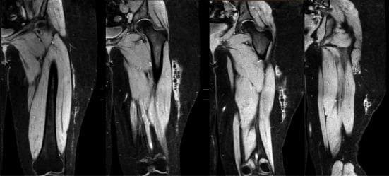 This diagnostic image consists of four coronal T2-weighted magnetic resonance imaging (MRI) slices of the left thigh. The imaging demonstrates a localized fluid collection situated in the lateral subcutaneous plane, superficial to the deep fascia and the iliotibial band. This finding is characteristic of a chronic Morel-Lavallée lesion, a post-traumatic internal degloving injury. The collection exhibits high T2 signal intensity with internal septations and a defined pseudocapsule, indicating a chronic stage. In the provided series, the lesion appears reduced in volume compared to previous examinations, as noted in the clinical context. The underlying musculature, including the quadriceps femoris and adductor groups, shows normal signal intensity without evidence of strain or edema. Key anatomical landmarks visible include the femur, hip joint, and knee joint. This image serves as an educational example of the long-term radiological presentation and follow-up of soft tissue shear injuries in orthopedic trauma.