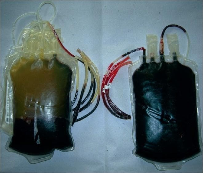 A clinical photograph displaying a side-by-side comparison of two whole blood units, illustrating the visual differences between normal and hemolyzed blood. The unit on the left represents a normal blood bag where distinct layering is visible: the upper portion contains clear, straw-colored (yellowish) plasma separated from the dark red sedimented red blood cells. The attached tubing segments on this bag also demonstrate clear, transparent plasma. In contrast, the unit on the right displays gross hemolysis, characterized by a uniform, dark reddish-black appearance throughout the entire bag. Crucially, the attached segments for the right-hand bag are filled with dark, opaque fluid instead of clear plasma, indicating the breakdown of red blood cells. This comparison serves as an educational tool for blood bank technicians and medical professionals to identify transfusion product contamination, thermal injury, or storage-related hemolysis during pre-issue inspections.