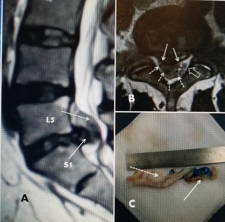 This composite educational image illustrates a large L5-S1 lumbar disc herniation through diagnostic imaging and gross pathology. Panel A is a sagittal T2-weighted MRI of the lumbar spine, demonstrating a significant posterior disc herniation at the L5-S1 level (solid arrow) with a more superiorly positioned extruded fragment (dotted arrow) causing posterior displacement of the dural sac. Panel B shows an axial MRI scan at the same level, highlighting the disc's posterior and lateral extension (solid arrow) and the surrounding extruded fragment pushing the thecal sac toward the contralateral side (open arrow). Panel C displays the surgical specimen following endoscopic discectomy. The removed material includes a portion of the nucleus pulposus stained with Indigo Carmine blue dye (solid arrow) and an attached extruded annulus fragment (dotted arrow) that had migrated into the spinal canal. A ruler in the frame indicates that the total length of the excised disc material exceeds 7 cm. This visual sequence is used to correlate radiological evidence of severe spinal canal compromise with postoperative clinical findings in neurosurgery and orthopedic pathology.