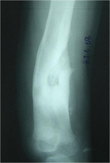 This diagnostic image is an anteroposterior x-ray radiograph of a long bone (tibia) demonstrating classic features of chronic haematogenous osteomyelitis. The radiograph reveals Type B3 classification findings characterized by the presence of a sequestrum—a dense, radiopaque segment of necrotic bone isolated from the surrounding living tissue. Encasing the sequestrum is a prominent involucrum, which appears as a thick layer of new periosteal bone formation. This involucrum is described as structural, sclerotic, and expanded, exhibiting significantly increased bone density and a widened diameter compared to normal bone morphology. The image illustrates the body's attempt to wall off infected necrotic tissue by creating a sheath of reactive bone. This visual is clinically significant for medical students and orthopedic specialists for identifying the radiographic hallmarks of pediatric chronic osteomyelitis and understanding the Beit CURE (BC) classification system for bone infections.