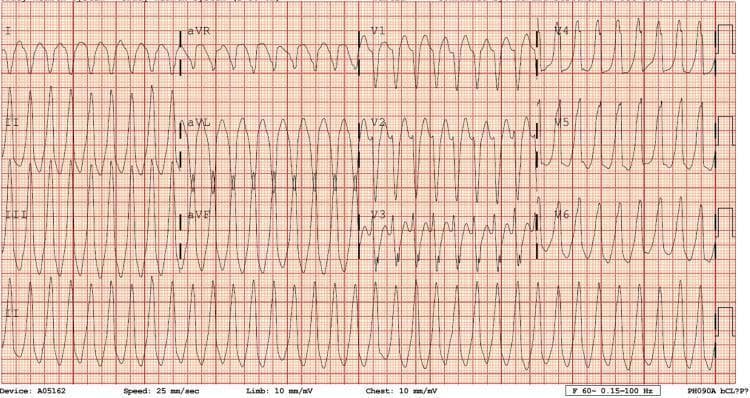 This diagnostic image is a 12-lead electrocardiogram (ECG) demonstrating a regular, monomorphic wide-complex tachycardia (WCT). The ventricular rate is approximately 250 beats per minute, characterized by widened QRS complexes that maintain a consistent morphology across each lead. P waves are not clearly discernible, and there is no obvious evidence of atrioventricular (AV) dissociation on this tracing, making it visually challenging to differentiate between ventricular tachycardia (VT) and supraventricular tachycardia (SVT) with aberrant conduction. Notably, the limb leads aVR and aVL exhibit signs of potential lead reversal, complicating axis determination. The rhythm is monomorphic, suggesting a uniform ventricular depolarization pathway. This ECG is a critical educational example used to illustrate the emergency department presentation of tachyarrhythmias, often requiring clinical correlation and potentially electrical cardioversion. It serves as a teaching tool for advanced cardiac life support (ACLS) and cardiology-level interpretation of life-threatening arrhythmias.