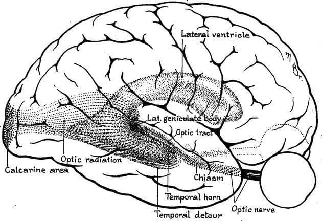 This anatomical diagram provides a lateral view of the human brain, specifically illustrating the visual pathway and the spatial distribution of the optic radiation. Based on Harvey Cushing's 1921 drawing, the illustration highlights the geniculocalcarine tract from its origin at the lateral geniculate body (LGB) to its termination in the primary visual cortex (calcarine area). A key educational focus is the 'temporal detour' or Meyer’s loop, where the ventral fibers of the optic radiation arc anteriorly around the temporal horn of the lateral ventricle before heading posteriorly toward the occipital lobe. Other labeled anatomical landmarks include the optic nerve, optic chiasm, optic tract, and the main body of the lateral ventricle. This diagram is significant for understanding neuroanatomy related to visual field deficits (e.g., quadrantanopia) that may arise from lesions or neurosurgical procedures in the temporal lobe, such as epilepsy surgery or tumor resection.