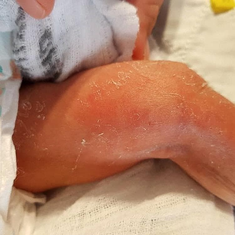 Clinical photograph of a neonatal left distal medial thigh showing an localized inflammatory skin reaction. The central area exhibits prominent erythema (redness) and visible surface desquamation (skin peeling), consistent with an extravasation injury or localized cellulitis. The affected region is described as indurated, though the borders are diffuse and lack sharp demarcation, fading into the surrounding normal skin tone. This visual presentation is characteristic of tissue irritation following intravenous (IV) infusion, where vesicant or irritant substances (such as human albumin or dextrose) have leaked into the subcutaneous space. The educational focus is on identifying early signs of extravasation, including erythema, swelling, and induration, which require prompt clinical intervention to prevent progression to necrosis or ulceration.