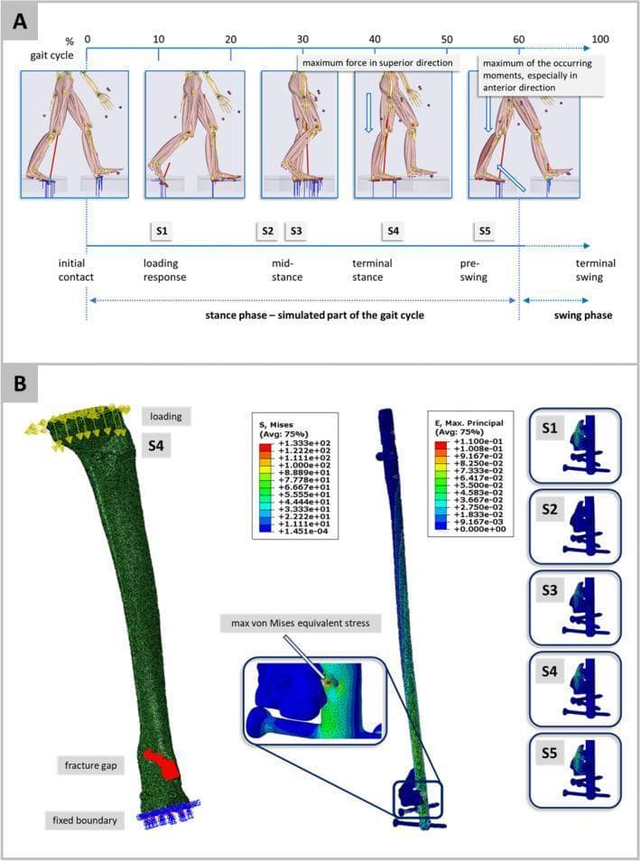 This composite educational graphic illustrates a biomechanical simulation of the gait cycle and its mechanical effects on an intramedullary tibial nail. Section A displays a gait cycle diagram (0-100%) divided into the stance and swing phases. Musculoskeletal models identify five specific landmarks: S1 (initial contact), S2 (loading response), S3 (mid-stance), S4 (terminal stance/maximum superior force), and S5 (pre-swing/maximum anterior moments). Section B presents Finite Element Analysis (FEA) results for a tibial fracture model fixed with an intramedullary nail. The primary simulation (S4) shows von Mises equivalent stress distribution across the implant using a color-coded heat map (blue for low stress, red for maximum stress), with a magnified view of the maximum stress point at the nail-screw interface. Additional frames (S1-S5) depict the maximum principal strain within the fracture gap across different gait phases. This material is designed to illustrate mechanobiological loading and the influence of gait dynamics on fracture gap micromechanics in orthopaedic rehabilitation.
