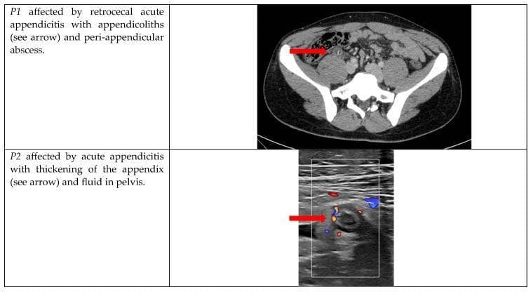 This composite educational graphic presents two diagnostic imaging modalities illustrating acute appendicitis. The top panel (P1) is a transverse axial CT scan of the lower abdomen and pelvis. A red arrow identifies signs of retrocecal acute appendicitis, characterized by the presence of hyperdense appendicoliths and an adjacent peri-appendicular abscess. Bony landmarks including the ilium and sacrum are visible. The bottom panel (P2) displays a Color Doppler ultrasound image in the transverse plane. A red arrow points to a thickened, non-compressible, blind-ended tubular structure consistent with an inflamed appendix. The Doppler overlay demonstrates increased peripheral vascularity (hyperemia) within the appendiceal wall, a hallmark of inflammation. These images serve to compare radiological findings across CT and ultrasonography in the context of complicated and uncomplicated appendicitis for medical training and surgical triage.