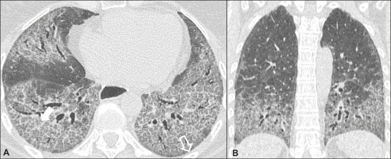 High-resolution computed tomography (HRCT) of the chest in a patient with scleroderma-associated nonspecific interstitial pneumonia (NSIP). Image A (axial view) demonstrates bilateral ground-glass attenuation interspersed with fine linear reticular opacities. Hallmark signs of fibrotic lung disease, including traction bronchiectasis and bronchiolectasis, are visible within the areas of lung parenchyma distortion. A characteristic feature of NSIP—subpleural preservation—is indicated by an open arrow, showing a narrow band of relatively spared lung tissue immediately adjacent to the pleura. Image B (coronal reformatted view) highlights the classic symmetric and predominantly basal distribution of the interstitial changes, with opacities increasing in severity toward the lung bases. These findings collectively represent the common imaging presentation of cellular and fibrotic NSIP within the context of systemic autoimmune disease. This diagnostic imaging serves as a clinical reference for identifying patterns of interstitial lung disease and differentiating NSIP from other patterns such as usual interstitial pneumonia (UIP).