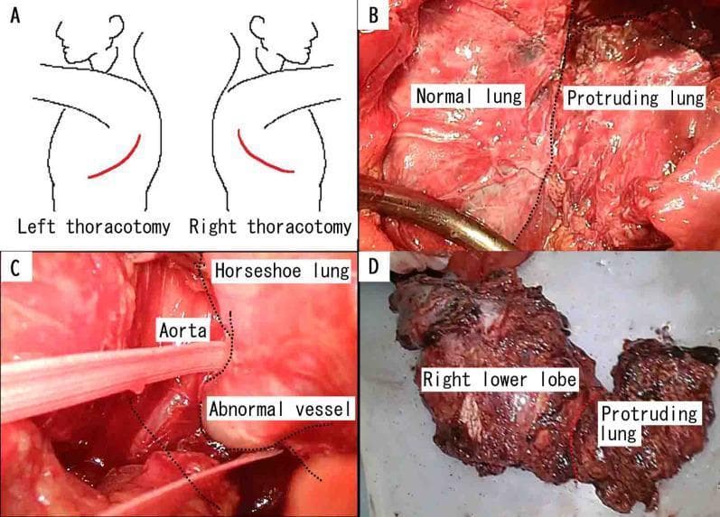 A composite medical figure illustrating surgical management of a horseshoe lung with extralobular sequestration. Panel A is an anatomical diagram showing bilateral posterolateral thoracotomy incision lines (red) on the left and right posterior thoracic wall. Panel B is an intraoperative clinical photograph during a left thoracotomy, distinguishing the native left lung from the abnormal 'protruding lung' tissue crossing the mediastinum. Panel C shows the surgical field identifying the descending aorta and a systemic abnormal blood vessel supplying the sequestered lung segment. Panel D displays the gross pathology specimen of the resected horseshoe lung, consisting of the right lower lobe and the continuous protruding lung tissue. The specimen appears dark and congested, consistent with chronic infection or aspergillosis. This content serves as an educational resource for thoracic surgery and congenital pulmonary malformations.