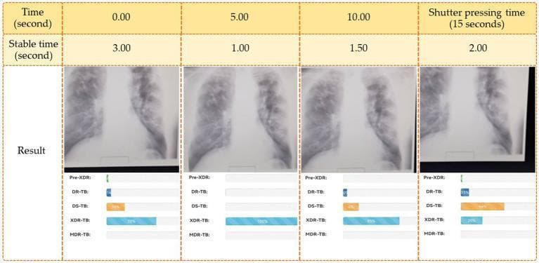 A comparison chart demonstrating a live image analysis interface for tuberculosis (TB) drug resistance diagnosis from chest X-rays (CXR). The graphic is divided into four chronological columns: 0.00 seconds, 5.00 seconds, 10.00 seconds, and shutter pressing time at 15 seconds. Each column displays a cropped diagnostic image focusing on the bilateral mid-to-lower lung fields and mediastinal borders. Below each image are AI-generated probability bars for five clinical classifications: Pre-XDR (pre-extensively drug-resistant TB), DR-TB (drug-resistant TB), DS-TB (drug-susceptible TB), XDR-TB (extensively drug-resistant TB), and MDR-TB (multidrug-resistant TB). The visual illustrates the real-time evolution of the deep learning model's diagnostic confidence. For instance, at 5.00 seconds, XDR-TB shows a 100% probability, while at the final shutter time (15 seconds), DS-TB becomes the most likely prediction at 66%. This infographic highlights the application of 'fast image analysis' in clinical informatics and infectious disease screening.
