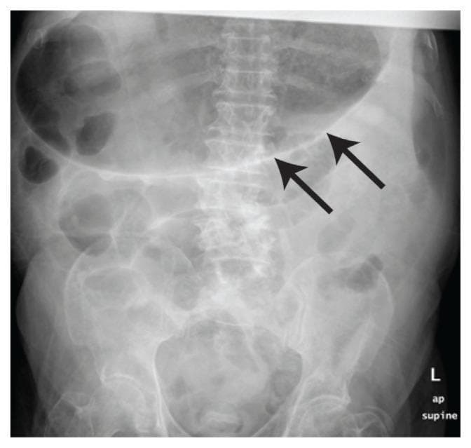 Diagnostic Image: Anteroposterior (AP) supine abdominal radiograph of an adult patient. The primary finding is a grossly distended stomach, visualized as a large, radiolucent (gas-filled) structure occupying the epigastrium and extending into the mid-abdomen (indicated by black arrows). The gastric wall appears relatively thin. There is a lack of multiple dilated small bowel loops or 'step-ladder' air-fluid levels, suggesting the absence of distal small bowel obstruction. No subdiaphragmatic free air is visible, excluding pneumoperitoneum in this view. The anatomical context shows the lumbar spine and pelvic girdle within normal radiological limits. This image is significant for evaluating acute abdominal distention, specifically highlighting gastric dilatation as a potential indicator of gastric outlet obstruction or gastroparesis.