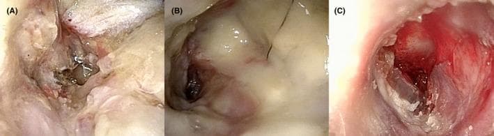 Three-panel endoscopic clinical photograph illustrating the progression of malignant otitis externa (MOE) and postoperative healing in the left external auditory canal. Panel (A), taken two weeks post-canal wall down mastoidectomy, shows a healing surgical cavity with pale granulation tissue and early epithelialization. Panel (B), at two weeks post-discharge, demonstrates clinical worsening characterized by a pale, edematous mass and purulent-appearing discharge obscuring the surgical site, associated with the emergence of MRSA. Panel (C), following readmission and targeted antibiotic treatment (vancomycin and cefepime/ceftazidime), shows intense erythema, raw inflammatory tissue, and active drainage (otorrhea) indicative of severe inflammation and skull base osteomyelitis. The sequence provides an educational visual timeline of surgical management, complication by antibiotic-resistant pathogens, and subsequent inflammatory response during systemic treatment in a high-risk patient with diabetes and chronic renal failure.