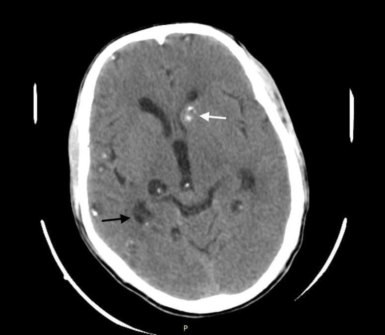 This diagnostic image is an axial non-contrast computed tomography (CT) scan of the brain demonstrating neurocysticercosis in multiple evolutionary stages. The scan shows numerous parenchymal cystic lesions distributed throughout both cerebral hemispheres. Two distinct stages are highlighted: the vesicular stage, marked by a black arrow, presents as a well-defined, low-attenuation (hypodense) fluid-filled cyst; and the nodular calcific stage, indicated by a white arrow, appearing as a high-attenuation (hyperdense) calcified lesion located in the left cerebral hemisphere near the basal ganglia. These lesions are characteristic of Taenia solium infection within the central nervous system. Anatomical landmarks including the cerebral cortex, lateral ventricles, and subcortical gray matter are visible, providing context for the multifocal distribution of the pathology. This image serves as a clinical example of the varied radiographic presentations of parasitic brain infections and is relevant for neurology and radiology education regarding seizure etiology.