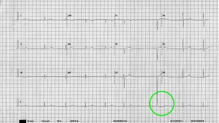 A 12-lead electrocardiogram (ECG) tracing on standard grid paper, demonstrating sinus node dysfunction and atrioventricular (AV) conduction abnormalities. The initial portion of the tracing shows a regular sinus rhythm at approximately 60 beats per minute, characterized by visible P waves preceding each narrow QRS complex. A green circle highlights a specific clinical finding in lead II and V6: a sudden pause caused by a blocked P wave (sinus arrest or high-grade exit block) followed by a narrow-complex junctional escape beat. This visual demonstrates common electrophysiological manifestations of sinus node dysfunction and high-grade AV block. The ECG includes limb leads (I, II, III), augmented limb leads (aVR, aVL, aVF), precordial leads (V1-V6), and a continuous Lead II rhythm strip at the bottom. The content is suitable for medical education regarding cardiac arrhythmias, specifically sinus arrest and escape rhythms.