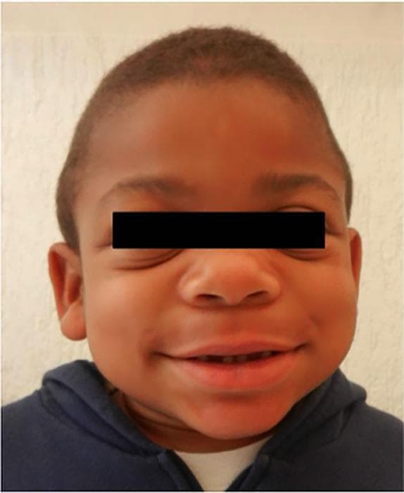 This clinical photograph of a pediatric patient demonstrates the classic 'coarse facial features' characteristic of mucopolysaccharidosis (MPS), specifically Hunter syndrome (MPS II). The visible dysmorphic features include a broad, flattened nasal bridge and a wide nasal tip. There is significant mid-face fullness with large, rounded cheeks and a prominent forehead. The lips are notably thickened (macrocheilia), and the patient exhibits a wide smile that reveals slightly irregular dental spacing. The overall facial contour is rounded with a lack of sharp definition, typical of the storage-related soft tissue and bony changes seen in lysosomal storage disorders. The ears appear slightly low-set. This image serves as a teaching tool for recognizing the phenotypic manifestations of metabolic diseases involving glycosaminoglycan accumulation.