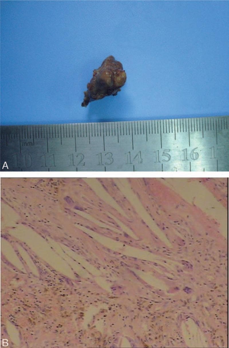 This composite educational image presents the macroscopic and microscopic features of a resected cholesterol granuloma, typically found in the sellar or suprasellar regions. Panel A is a clinical photograph of the gross specimen, showing an irregularly shaped, lobulated tumor that is ash-black in color. A surgical ruler provides scale, indicating dimensions of approximately 2.5 cm by 1.5 cm. Panel B displays a light microscopy image (hematoxylin and eosin staining, 200x magnification) revealing characteristic histopathological features. Prominent needle-like or spindle-shaped empty spaces represent cholesterol clefts where crystals have dissolved during processing. These are surrounded by a chronic inflammatory infiltrate, including multinucleated foreign body giant cells and macrophages. Additionally, areas of hemorrhage and brownish hemosiderin-laden deposits are visible, indicating prior intralesional bleeding. This visual material is used in neurosurgery and pathology to differentiate cholesterol granulomas from other sellar lesions like craniopharyngiomas based on classic pathological landmarks.