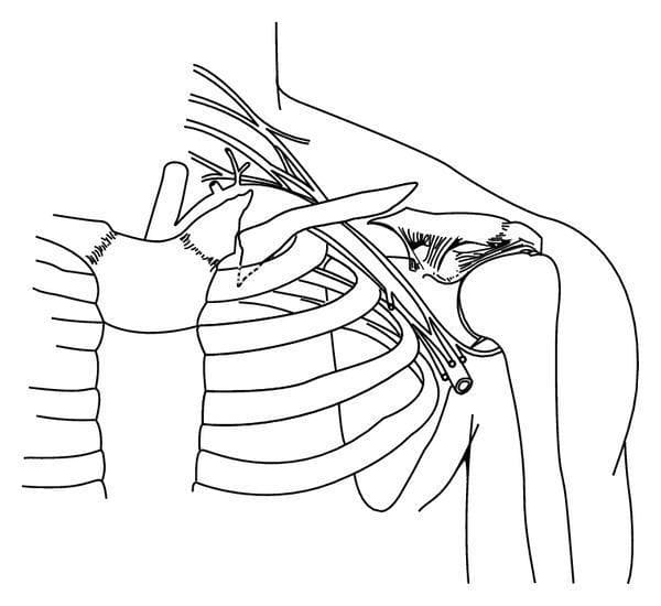 This anatomical illustration depicts a double fracture pattern of the left clavicle in an adult male. The drawing highlights two distinct fracture sites: an established medial nonunion and an acute lateral fracture. The medial fracture, located in the proximal third of the clavicle shaft, is characterized by a prominent, inferiorly directed bony spike. This spike is shown in close anatomical proximity to the lung apex and the first rib, illustrating the potential risk for intrathoracic complications such as pneumothorax. The lateral fracture is situated in the distal third of the clavicle shaft, presenting as a relatively clean, acute break without the significant remodeling seen in the medial nonunion. The illustration includes skeletal landmarks such as the sternum, rib cage, and humeral head, along with neurovascular structures passing beneath the clavicle. This diagram serves as an educational tool for identifying complex clavicular fracture patterns and understanding their spatial relationship to critical thoracic and vascular anatomy.