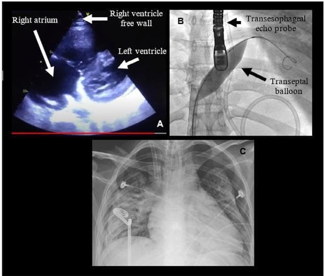 This composite clinical figure illustrates the diagnosis and management of severe pulmonary hypertension and its complications. Panel A shows a transthoracic echocardiogram (TTE) in a patient with acute cor pulmonale. Labeled structures include a dilated right atrium and left ventricle, with an arrow highlighting the right ventricle free wall, demonstrating significant right heart strain. Panel B is a fluoroscopic image capturing an atrioseptostomy procedure. It depicts a transesophageal echo (TEE) probe positioned in the esophagus and a transeptal balloon inflated across the interatrial septum to create a right-to-left shunt. Panel C is an anteroposterior thoracic X-ray demonstrating bilateral pneumothorax with limited lung expansion. Visible medical devices include bilateral thoracic drainage tubes (chest tubes), an endotracheal tube, and ECG leads. The image set provides a comprehensive visual summary of hemodynamic monitoring, interventional rescue maneuvers for right ventricular failure, and subsequent pulmonary complications in a critical care setting.