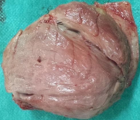This clinical photograph displays a gross surgical specimen of an excised vulvar tumor, later histologically confirmed as a desmoid tumor (aggressive fibromatosis). The specimen is a solid, irregularly shaped, and lobulated mass with a predominantly pinkish-tan, fleshy appearance. Its surface is moist and glistening, revealing a dense, fibrous texture with visible fascicular striations across the parenchyma. There is no clear evidence of a distinct capsule, which correlates with the infiltrative growth pattern typical of desmoid fibromatosis and the clinical report of a difficult dissection with an absent cleavage plane. The mass shows focal areas of congestion and small irregular voids. This image illustrates the macroscopic features of a mesenchymal tumor arising from the deep soft tissues of the vulva, emphasizing the non-encapsulated, fibrous nature that distinguishes aggressive fibromatosis from simple cysts of the Bartholin gland.