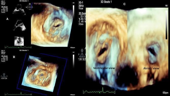 This diagnostic image set consists of 3D transthoracic echocardiography (TTE) frames showcasing severe mitral valve stenosis in a patient with Rheumatic Heart Disease (RHD). Panel A provides an atrial view with corresponding 2D reference planes. Panel B displays a volumetric 3D zoom of the mitral apparatus. Panel C provides a side-by-side comparison of the stenotic valve from the ventricular (left) and atrial (right) perspectives. The imaging demonstrates classic morphological hallmarks of rheumatic mitral stenosis, including significant thickening and calcification of the valve leaflets and commissural fusion. The valvular orifice is markedly reduced, exhibiting the characteristic 'fish-mouth' or 'buttonhole' appearance. The 3D reconstructions highlight the funnel-shaped deformity of the mitral apparatus and the restricted mobility of the fused cusps. These views are essential for assessing valvular area, subvalvular involvement (such as chordae retraction), and suitability for percutaneous mitral balloon valvuloplasty or surgical intervention.