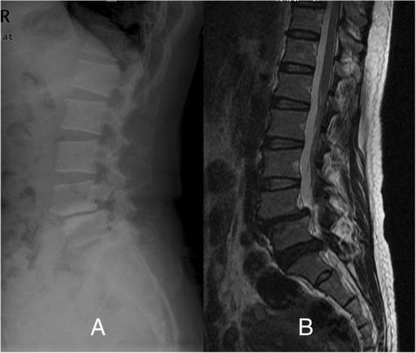 This composite diagnostic image displays a lateral X-ray (A) and a sagittal MRI (B) of the lumbar spine. The lateral radiograph demonstrates an anterior displacement of the L4 vertebral body relative to L5, characteristic of spondylolisthesis. There is evidence of spondylolysis, visible as a lucent defect in the pars interarticularis of the L4 vertebra. The sagittal MRI (B) provides a detailed view of the soft tissues and spinal canal, highlighting a significant disc protrusion at the L5/S1 level. This herniation causes mechanical compression of the thecal sac and likely impacts the descending L5 and S1 nerve roots. The imaging illustrates the mechanical instability of the mid-lumbar spine combined with secondary degenerative disc disease and neural foraminal/canal stenosis. These findings are clinically relevant for evaluating chronic low back pain, radiculopathy, and dermatomal sensory deficits in the lower extremities.