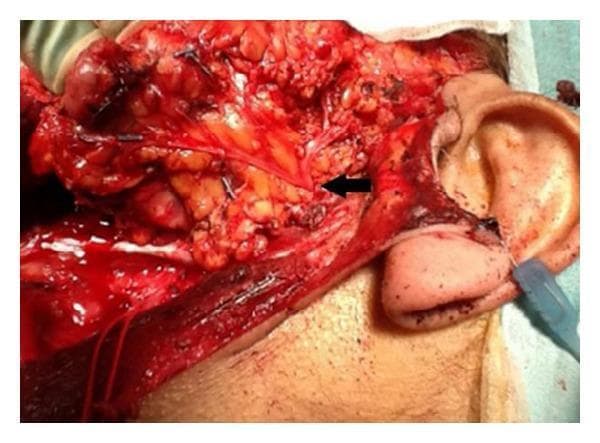 This clinical photograph displays a lateral view of an intraoperative surgical field following a subtotal parotidectomy. The image focuses on the preauricular and cervical regions, where the skin has been reflected to reveal the underlying anatomy. A black arrow indicates the pes anserinus of the facial nerve (Cranial Nerve VII) as it emerges from the parotid gland region. Clearly visible are the thin, yellowish-white, thread-like neural branches radiating from this central point, representing the temporal, zygomatic, buccal, marginal mandibular, and cervical branches. These nerves are preserved and meticulously dissected amidst the surrounding erythematous soft tissue and adipose deposits. The external ear is visible on the right as a landmark, with the neck and jawline extending inferiorly and anteriorly. The image demonstrates surgical anatomy crucial for preventing iatrogenic facial nerve injury during parotid gland surgery, highlighting the spatial relationship between the nerve branches and the deep salivary tissue.