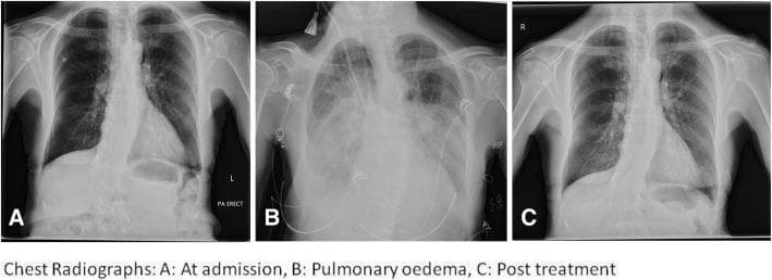 This clinical imaging figure consists of three serial posteroanterior (PA) chest radiographs (labeled A, B, and C) illustrating the progression and resolution of acute pulmonary edema. Image A (At admission) shows relatively clear lung fields with visible vascular markings and a cardiac silhouette demonstrating mild cardiomegaly, but no active parenchymal disease. Image B (Pulmonary edema) captures a hypertensive emergency state, characterized by significant bilateral air space opacifications, perihilar haze (bat-wing distribution), and obscured costophrenic angles consistent with pleural effusions. Interventional artifacts, including ECG leads and potentially a central venous catheter or monitoring lines, are visible. Image C (Post treatment) demonstrates marked clinical improvement following diuretic and vasodilator therapy, showing near-complete resolution of the bilateral opacities and restoration of lung field lucency. This series serves as a diagnostic comparison for identifying radiographic signs of acute heart failure and pulmonary congestion, emphasizing the dynamic changes in pulmonary vasculature and alveolar aeration during treatment.