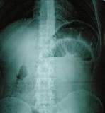 This diagnostic image is an erect abdominal plain radiograph (X-ray) demonstrating signs of a small bowel obstruction. The radiograph reveals multiple dilated loops of small bowel in the mid and upper abdomen. A classic radiographic hallmark of mechanical obstruction is present: distinct horizontal air-fluid levels, where radiolucent (dark) gas is visible superior to radio-opaque (lighter) fluid within the distended bowel lumen. The valvulae conniventes (plicae circulares) are identifiable crossing the full width of the dilated loops, confirming a small bowel rather than large bowel origin. The distribution is widespread, involving multiple quadrants, which is consistent with a generalized proximal or mid-small bowel obstructive process. This image serves as a clinical example for medical students and clinicians in identifying the 'stepladder' appearance or air-fluid level sign associated with pathologies such as intussusception or adhesive disease.