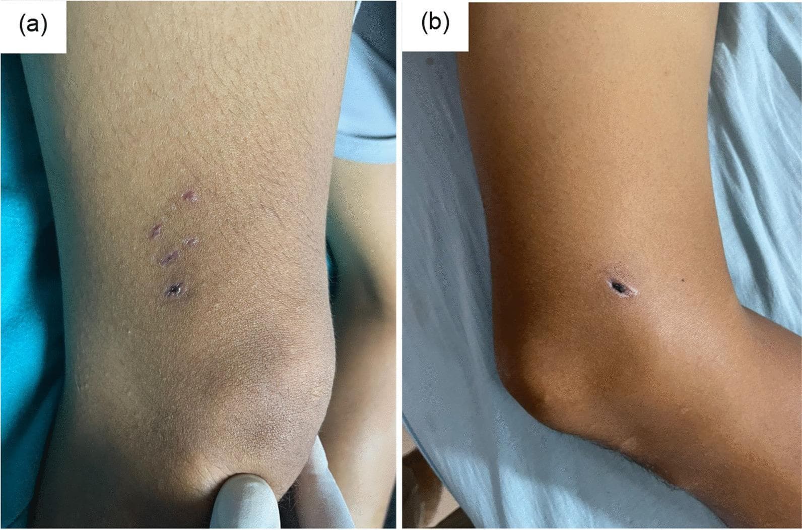 Clinical photograph of the right lower extremity in a 35-year-old patient demonstrating healing skin lesions from a dog bite occurring 25 days prior. (a) Lateral view of the distal thigh shows three well-defined, linear healing lacerations arranged in a pattern consistent with canine dentition. The wounds exhibit pink-to-purple post-inflammatory hyperpigmentation with closed edges and no signs of active discharge or perilesional cellulitis. (b) Medial view of the same limb reveals a single, 1 cm deep puncture wound characterized by a prominent, dry, black necrotic scab (eschar). The surrounding skin shows mild induration but lacks significant erythema or fluctuance, suggesting a dry healing state without secondary bacterial infection. These images represent characteristic cutaneous manifestations of animal bite trauma and are contextually linked to a clinical case of rabies encephalomyelitis, emphasizing the importance of identifying primary inoculation sites in zoonotic disease workups.
