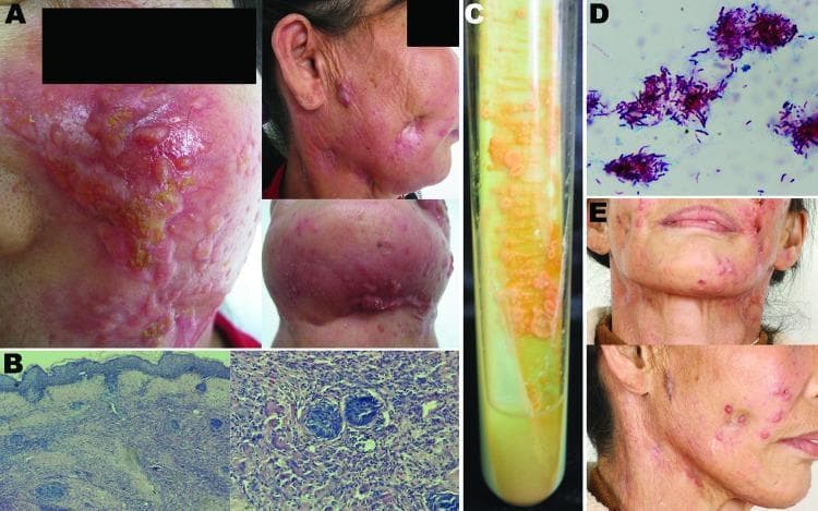 This composite educational image details a case of cutaneous Mycobacterium shigaense infection. Panel A features clinical photographs of a 56-year-old patient's face and neck, presenting with extensive reddish papules, nodules, and indurated plaques, along with concave scarring and crusting indicative of chronic skin involvement. Panel B provides histopathological micrographs showing epidermal hyperplasia and deep dermal granulomatous inflammation containing multinucleated giant cells and epithelioid cell infiltrates. Panel C demonstrates microbiology via a Löwenstein-Jensen medium slant, showing the growth of smooth, creamy, yolk-yellow bacterial colonies. Panel D displays a microscopic Ziehl-Neelsen stain (acid-fast stain) highlighting numerous bright pink/purple acid-fast bacilli clustered together against a blue background. Panel E presents clinical follow-up photographs showing marked resolution of active inflammation and flattening of lesions after four months of antimicrobial therapy, leaving behind atrophic and hyperplastic scars. This visual sequence is intended for the study of infectious dermatology, specifically atypical mycobacterial infections and their diagnostic confirmation through histology and culture.