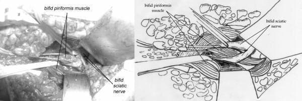 The image consists of a side-by-side comparison: a grayscale clinical photograph of an intraoperative field and a corresponding anatomical line drawing. The focus is on a rare anatomical variation involving the gluteal region. Both the photograph and the diagram depict a bifid piriformis muscle, where the muscle is split into two distinct bellies. Associated with this is a bifid sciatic nerve, which has divided into its common peroneal and tibial components more proximally than usual. The spatial relationship between these structures is highlighted: one branch of the sciatic nerve passes superior (proximal) to the piriformis muscle, while the second branch passes directly through the cleft or split between the two bellies of the bifid muscle. This anatomical arrangement is clinically significant in the context of piriformis syndrome, as it demonstrates a potential mechanism for nerve entrapment or impingement within the sciatic notch. The images provide high-level anatomical detail for surgical planning and medical education in orthopedics, neurology, and anatomy.