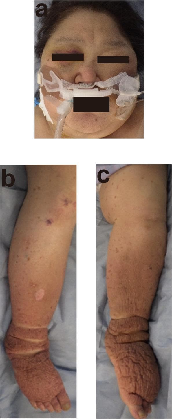 This composite of three clinical photographs displays the systemic physical manifestations of severe hypothyroidism, specifically myxedema. Image (a) is a facial photograph showing generalized periorbital and facial puffiness (myxedematous facies) and thinning of the lateral eyebrows (Queen Anne's sign). The patient is intubated, with medical stabilization equipment and digital obscuration of the eyes and mouth present. Images (b) and (c) illustrate the lower extremities, demonstrating severe, systemic non-pitting edema. The skin on the legs and feet appears thickened, doughy, and markedly wrinkled with deep cutaneous folds around the ankles, characteristic of mucopolysaccharide deposition in the dermis. There is noticeable erythema of the feet, scattered petechiae or small blemishes, and a localized hypopigmented patch on the right pretibial region. These findings are clinically diagnostic of myxedema coma presentation in an endocrine emergency context.