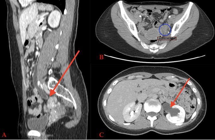 This composite diagnostic image features three contrast-enhanced CT views demonstrating severe obstructive uropathy. Image A (sagittal view) shows a significantly dilated left ureter (hydroureter) extending inferiorly toward a pelvic mass (indicated by a red arrow). Image B (axial pelvic view) highlights a spiculated, circular mass in the left adnexal region (circled), which is inseparable from the adjacent ureteral segment, suggesting intrinsic or extrinsic invasion. Image C (axial abdominal view) illustrates severe left hydronephrosis characterized by a markedly dilated renal pelvis (arrow) and thinning of the renal parenchyma compared to the normal right kidney. Notably, there is an absence of contrast flow within the dilated left collecting system, indicating complete obstruction. These findings are clinically consistent with ureteral endometriosis causing high-grade urinary tract obstruction. This material is suitable for medical education regarding radiological signs of hydronephrosis and differential diagnoses for ureteral masses in female patients.