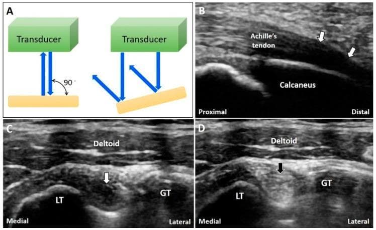 This educational composite focuses on the ultrasound artifact of anisotropy in musculoskeletal imaging. Panel A is a physics diagram illustrating that the ultrasound beam is reflected back to the transducer when incident at 90 degrees, but reflected away when the target is oblique, leading to signal loss. Panel B shows a long-axis ultrasound view of the Achilles tendon insertion on the calcaneus. White arrows indicate a hypoechoic (dark) area caused by anisotropy where the tendon fibers curve, which could be mistaken for tendinopathy or a tear. Panels C and D provide a short-axis comparison of the long head of the biceps tendon within the bicipital groove, situated between the lesser tubercle (LT) and greater tubercle (GT) under the deltoid muscle. In Panel C, a white arrow points to an anisotropic hypoechoic region within the tendon. Panel D demonstrates the resolution of the artifact (black arrow) after tilting the transducer to achieve a perpendicular angle of insonation, restoring normal hyperechoic fibrillar echogenicity. This figure teaches clinicians how to differentiate technical artifacts from true pathology during musculoskeletal ultrasound examinations.