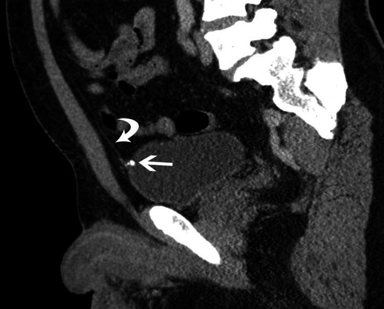 This diagnostic image is a sagittal reformatted CT scan of the lower abdomen and pelvis. It highlights a midline cord-like structure (curved arrow) identified as the median umbilical ligament, which represents a urachal remnant. This ligament is seen extending superiorly from the apex of the urinary bladder toward the umbilicus. At the point of insertion onto the anterior inner wall of the urinary bladder, a distinct hyperdense, punctate focus (straight arrow) is visible, measuring approximately 7mm, which represents a calcification of the urachal remnant. The anterior bladder wall is smooth and demonstrates no evidence of focal outpouching or diverticulum formation at the site of ligamentous attachment. This image is clinically significant for diagnosing incidental urachal calcifications and serves to differentiate the condition from urachal diverticula or other umbilical abnormalities. The content is suitable for medical students and radiology residents studying embryological remnants and pelvic anatomy.