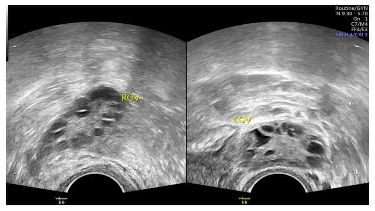 Two side-by-side grayscale pelvic ultrasound images displaying the right ovary (ROV) and left ovary (LOV) in a patient with polycystic ovary syndrome (PCOS). Both ovaries demonstrate classic polycystic ovarian morphology (PCOM). Each ovary contains numerous small, hypoechoic (dark), round-to-oval structures representing immature antral follicles, typically measuring 2–9 mm. The follicles are primarily arranged in a peripheral distribution, often referred to as the 'string of pearls' or necklace sign. The central ovarian stroma is notably hyperechoic (brighter) and appears increased in volume, a common feature of the androgen-induced stromal hyperplasia seen in PCOS. This diagnostic imaging is used in the Rotterdam criteria to identify ovarian dysfunction and chronic anovulation. The image is captured using a transvaginal probe, providing high-resolution visualization of the follicular arrangement and stromal density essential for gynecological and reproductive endocrinology assessment.
