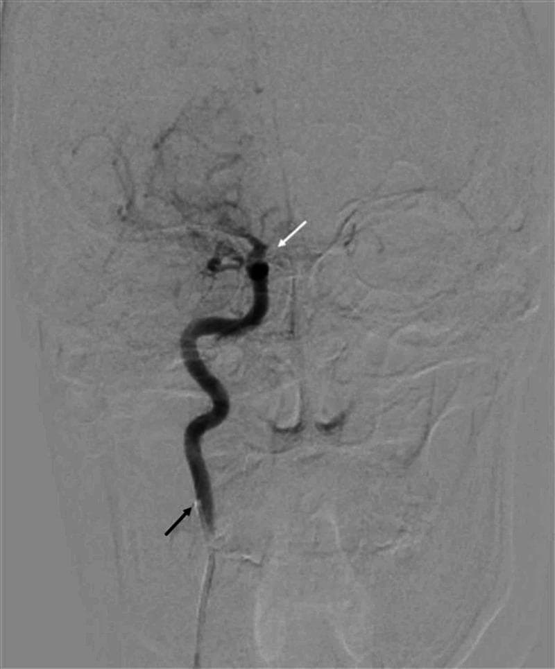 This diagnostic image is a cerebral angiogram of the right internal carotid artery (ICA) using digital subtraction angiography (DSA) in an anteroposterior (AP) view. The image demonstrates a complete vascular occlusion. The catheter tip is positioned in the proximal segment of the right ICA, indicated by a black arrow, where normal contrast opacification is initially observed. Following the course of the vessel superiorly, there is an abrupt cessation or 'cut-off' of contrast flow distal to the origin of the ophthalmic branch, marked by a white arrow. This lack of distal opacification indicates a complete occlusion of the ICA, preventing the filling of the right middle cerebral artery (MCA) and anterior cerebral artery (ACA). The faint outlines of the skull and facial bones are visible in the background due to the subtraction technique. This clinical finding is significant for diagnosing acute ischemic stroke or underlying vasculopathy in the cerebrovascular system.