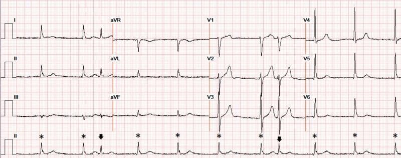 A 12-lead electrocardiogram (ECG) demonstrating severe sinus bradycardia with a heart rate of approximately 60 beats per minute. The rhythm exhibits atrial quadrigeminy, characterized by a repeating pattern where every fourth complex is a premature atrial complex (APC), marked by arrows in the rhythm strip (lead II). These APCs are followed by a compensatory pause and are coupled at an interval of approximately 550 ms. Several QRS complexes, marked with asterisks (*), lack preceding visible P-waves, suggesting a competing junctional escape rhythm or junctional beats emerging due to the underlying sinus bradycardia. The QRS complexes maintain a narrow morphology, and the ST segments and T-waves appear normal without signs of acute ischemia or electrolyte-induced peaking. This ECG illustrates complex rhythm disturbances including escape-capture sequences and ectopy in the clinical context of chronic kidney disease and electrolyte fluctuations.