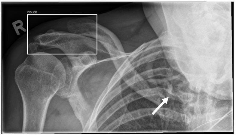 A standing anteroposterior (AP) radiograph of the right shoulder and upper thoracic region. Anatomical structures include the proximal humerus, scapula, clavicle, and the upper rib cage. The image demonstrates two distinct traumatic injuries. First, a white bounding box labeled 'DISLOK' highlights a dislocation at the acromioclavicular (AC) joint. Second, a white arrow points to a displaced fracture of the proximal clavicle near the sternoclavicular region, characterized by cortical disruption and bony overriding. The radiograph also contains an 'R' marker indicating the right side. This image is used in medical education to illustrate the clinical presentation of multiple injuries in the shoulder girdle and the utility/limitations of AI-assisted fracture and dislocation detection in a diagnostic imaging workflow.