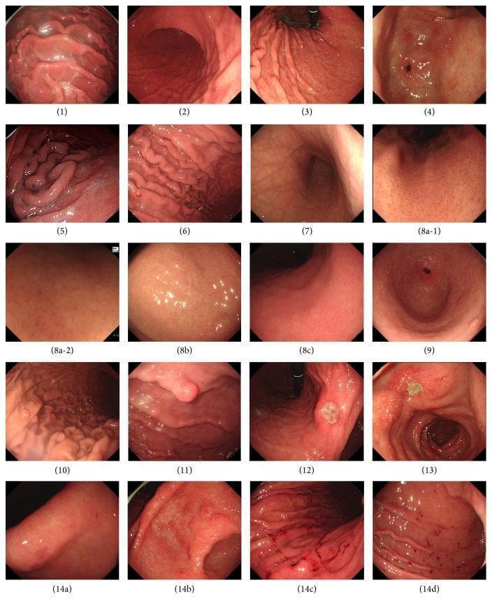 A composite panel of seventeen high-definition gastroscopy images illustrating common endoscopic features of the gastric and duodenal mucosa, categorized according to the Sydney System for gastritis. The images demonstrate variations in mucosal vascularity and inflammation, including diffuse redness (2), spotty redness (3), and patchy redness (4). Specific vascular patterns are shown through the Regular Arrangement of Collecting venules (RAC) in both conventional (8a-1) and magnifying endoscopy (8a-2). Pathological findings include mucus adhesion (1), enlarged rugal folds (5), mucosal edema (6), xanthoma (9), and various polyps such as fundic gland (10) and hyperplastic types (11). Ulcerative lesions are represented by gastric (12) and duodenal (13) ulcers. A detailed series on erosions (14a-d) compares flat, raised, hemorrhagic, and punctate bleeding spot morphologies. This comparison chart serves as an educational reference for gastroenterologists to differentiate between normal mucosal variants, Helicobacter pylori-associated changes, and peptic ulcer disease.