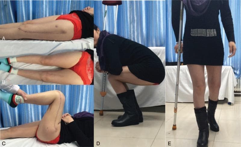 This composite of clinical photographs documents the 6-month post-operative recovery of a patient following a complex orthopedic procedure, likely tumor resection and revision knee arthroplasty of the left femur. Panel A shows the left lower limb in extension, highlighting a long (approx. 25 cm), well-healed longitudinal surgical scar on the anterior aspect of the thigh and knee. Panel B provides a bilateral comparison of the legs, showing relatively equal limb length. Panel C demonstrates passive knee flexion, confirming a functional range of motion and the stability of the surgical site. Panel D illustrates the patient’s functional mobility, showing the ability to perform an independent squat, albeit with support from an axillary crutch. Panel E shows the patient ambulating with the assistance of a single crutch and wearing a supportive boot on the left leg. This educational series highlights post-operative outcomes in orthopedic oncology and reconstructive surgery, emphasizing the restoration of range of motion and gait following significant limb salvage procedures.