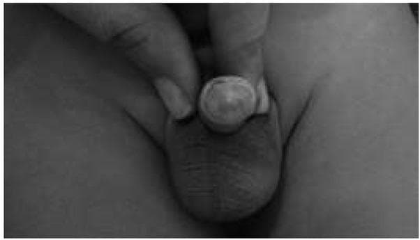 A grayscale clinical photograph of a pediatric male patient's genitals demonstrating a non-retractile prepuce, classified as Kikiros Grade 1. The image shows manual retraction of the foreskin using a finger to expose the glans penis. Only a small, central portion of the glans is visible through a narrowed preputial orifice. The surrounding foreskin appears smooth but tight, indicating significant phimosis where the preputial opening is insufficient for full retraction over the glans corona. This visual serves as an educational example for the Kikiros and Woodward classification system used in pediatric urology to grade the severity of phimosis. The educational focus is on identifying the degree of prepuce extensibility and the visible proportion of the glans in a clinical examination context.