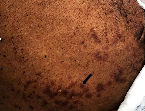 Clinical photograph of the abdomen on a dark-skinned patient demonstrating a purpuric rash. The primary visual finding is a periumbilical distribution of reddish-purple macules and patches. These lesions are both discrete and confluent, extending laterally toward the flanks. A black arrow points to a representative cluster of purpuric spots. In the clinical context of Strongyloides stercoralis hyperinfection or dissemination (as suggested by the associated metadata), this visual manifestation is classically known as the 'thumbprint sign' or 'larva currens' when presenting as migrating serpiginous tracks, though here it appears more as stationary petechiae and ecchymoses. The skin shows normal hair distribution and no overt signs of ulceration. This image is an essential educational example of cutaneous manifestations related to parasitic dissemination in immunocompromised individuals, illustrating the dermatological signs of severe systemic infection.