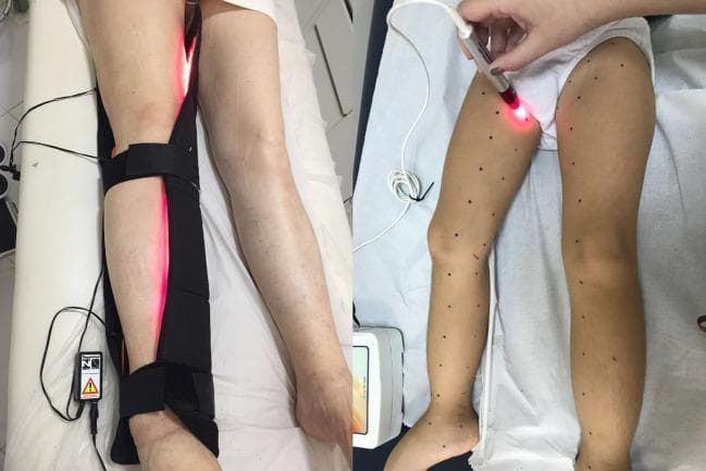 This clinical photograph illustrates two distinct methods of applying photobiomodulation (PBM) therapy, also known as low-level laser therapy (LLLT), to the lower limbs of a patient with lymphedema. The left panel demonstrates a stationary application using a black wrap-around applicator secured to the lower leg with adjustable straps; the device emits a continuous vertical line of therapeutic red light (650-1000 nm range) and is connected via a cable to a control unit. The right panel depicts a targeted, point-by-point application using a handheld laser wand being applied to the medial thigh. In this panel, the patient's skin is marked with a black grid pattern of dots, serving as reference points for precise irradiance delivery. This therapeutic modality is utilized in physical therapy and lymphology to manage inflammation, enhance lymphatic motility, and prevent tissue fibrosis in chronic edematous conditions. The image effectively compares static wide-field delivery versus dynamic localized treatment techniques in a clinical setting.
